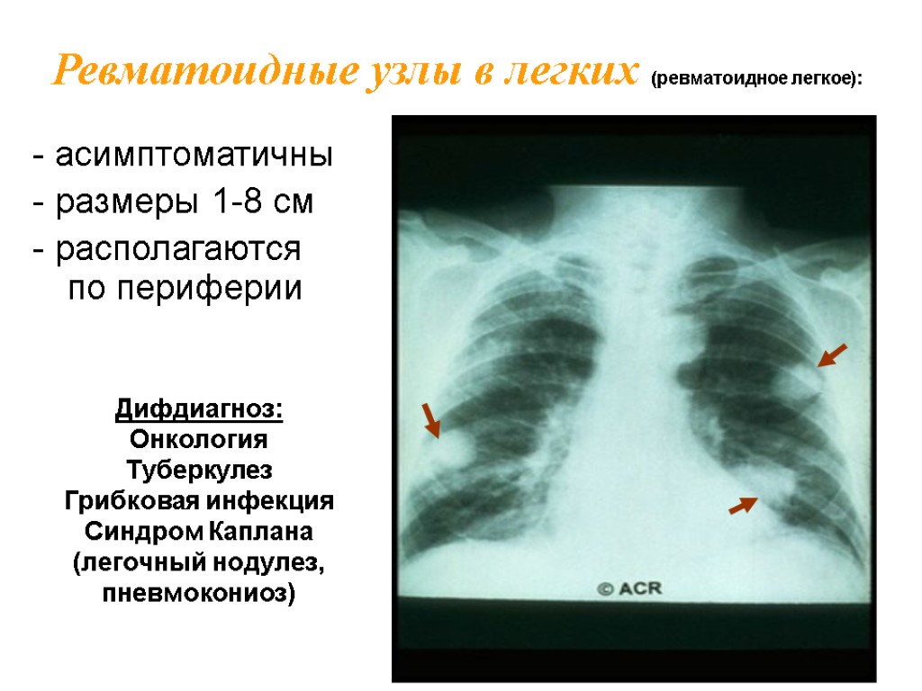 - асимптоматичны - размеры 1-8 см - располагаются по периферии Ревматоидные узлы в легких